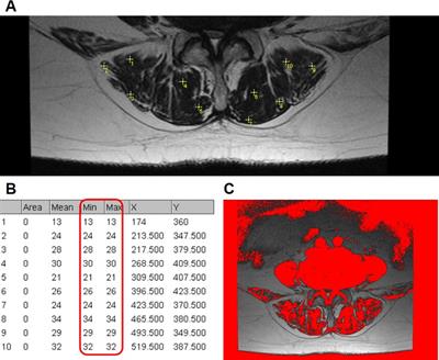 Identification of preoperative radiological risk factors for reoperation following percutaneous endoscopic lumbar decompression to treat degenerative lumbar spinal stenosis